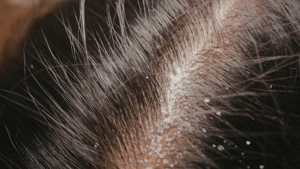 The Secret to Thicker Hair. Why Natural Scalp Care Beats Chemical Treatments
